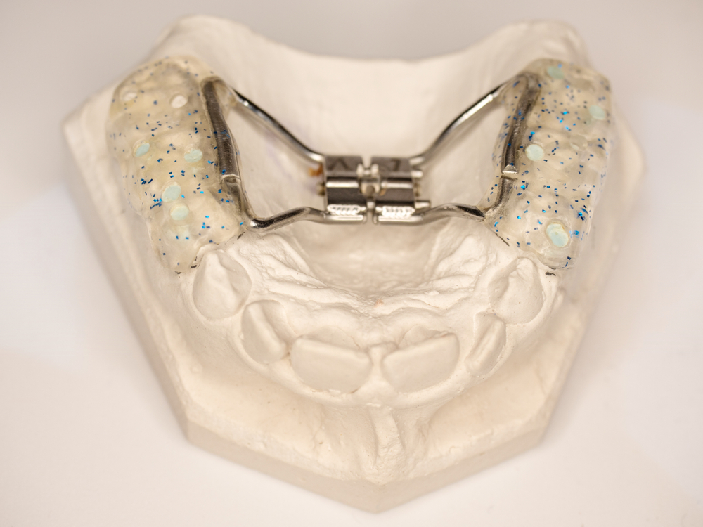 Check,Hyrax,Braces,On,Dental,Gypsum,Model.,Banded,Hyrax,Expander